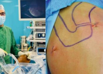 लुम्बिनी प्रादेशिक अस्पतालमा कुमको जोर्नीको दुरबिन प्रविधिबाट आर्थ्रोस्कोपी शल्यक्रिया