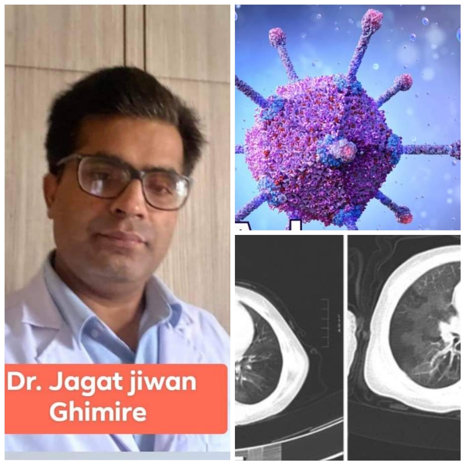 Dr. Jagat Jeevan Ghimire - एडेनो भाइरस संक्रमण र यो सँग सम्बन्धित ब्रोङकियोलाइटिस अब्लिटरेन्स सम्बन्धि जानकारी एडेनो भाइरस संक्रमण र यो सँग सम्बन्धित ब्रोङकियोलाइटिस अब्लिटरेन्स सम्बन्धि जानकारी