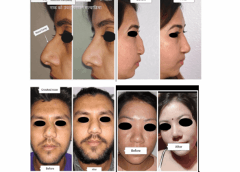 Rhinoplasty Before & After Photos