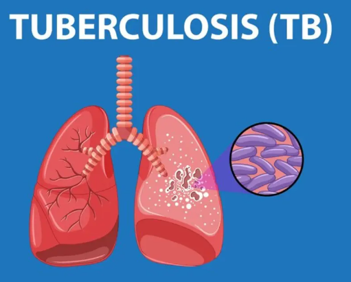 TB Tuberculosis