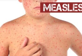 कञ्चनपुरमा बालबालिकालाई दादुरा-रुबेला विरुद्धको खोप अभियान