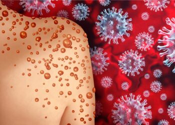 मंकीपक्सका लक्षण कस्ता हुन्छन्, रोकथामका लागि के गर्ने ?